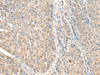 Immunohistochemistry of paraffin-embedded Human liver cancer tissue  using ASS1 Polyclonal Antibody at dilution of 1:35(×200)
