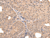 Immunohistochemistry of paraffin-embedded Human ovarian cancer tissue  using ATF7 Polyclonal Antibody at dilution of 1:40(×200)