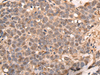 Immunohistochemistry of paraffin-embedded Human thyroid cancer tissue  using ATRIP Polyclonal Antibody at dilution of 1:40(×200)