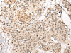 Immunohistochemistry of paraffin-embedded Human prost ate cancer tissue  using BATF Polyclonal Antibody at dilution of 1:45(×200)