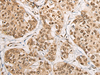 Immunohistochemistry of paraffin-embedded Human prost at e cancer tissue  using PHF21A Polyclonal Antibody at dilution of 1:50(×200)