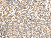 Immunohistochemistry of paraffin-embedded Human esophagus cancer tissue  using PHF21A Polyclonal Antibody at dilution of 1:50(×200)