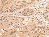 Immunohistochemistry of paraffin-embedded Human esophagus cancer tissue  using BPGM Polyclonal Antibody at dilution of 1:70(×200)