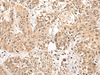 Immunohistochemistry of paraffin-embedded Human prost ate cancer tissue  using NCAPH Polyclonal Antibody at dilution of 1:45(×200)