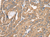 Immunohistochemistry of paraffin-embedded Human thyroid cancer tissue  using BCHE Polyclonal Antibody at dilution of 1:40(×200)