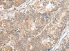 Immunohistochemistry of paraffin-embedded Human gastric cancer tissue  using BCHE Polyclonal Antibody at dilution of 1:40(×200)