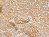 Immunohistochemistry of paraffin-embedded Human liver cancer tissue  using C1orf112 Polyclonal Antibody at dilution of 1:110(×200)