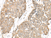 Immunohistochemistry of paraffin-embedded Human thyroid cancer tissue  using COA7 Polyclonal Antibody at dilution of 1:55(×200)
