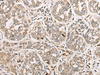 Immunohistochemistry of paraffin-embedded Human esophagus cancer tissue  using COA7 Polyclonal Antibody at dilution of 1:55(×200)