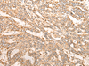Immunohistochemistry of paraffin-embedded Human liver cancer tissue  using GATD3B Polyclonal Antibody at dilution of 1:35(×200)