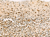 Immunohistochemistry of paraffin-embedded Human cervical cancer tissue  using C3orf38 Polyclonal Antibody at dilution of 1:80(×200)