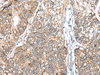 Immunohistochemistry of paraffin-embedded Human gastric cancer tissue  using NADK2 Polyclonal Antibody at dilution of 1:40(×200)