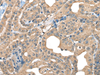 Immunohistochemistry of paraffin-embedded Human thyroid cancer tissue  using CABP5 Polyclonal Antibody at dilution of 1:65(×200)