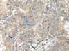 Immunohistochemistry of paraffin-embedded Human gastric cancer tissue  using CASR Polyclonal Antibody at dilution of 1:60(×200)