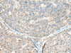 Immunohistochemistry of paraffin-embedded Human liver cancer tissue  using CASR Polyclonal Antibody at dilution of 1:60(×200)