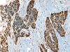 Immunohistochemistry of paraffin-embedded Human thyroid cancer tissue  using CALML5 Polyclonal Antibody at dilution of 1:70(×200)