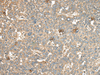 Immunohistochemistry of paraffin-embedded Human liver cancer tissue  using CA11 Polyclonal Antibody at dilution of 1:45(×200)
