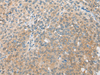 Immunohistochemistry of paraffin-embedded Human liver cancer tissue  using CBR3 Polyclonal Antibody at dilution of 1:35(×200)