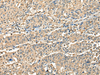 Immunohistochemistry of paraffin-embedded Human prost at e cancer tissue  using CCDC112 Polyclonal Antibody at dilution of 1:45(×200)