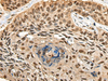 Immunohistochemistry of paraffin-embedded Human esophagus cancer tissue  using CCDC112 Polyclonal Antibody at dilution of 1:45(×200)