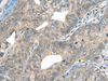 Immunohistochemistry of paraffin-embedded Human gastric cancer tissue  using CDADC1 Polyclonal Antibody at dilution of 1:60(×200)