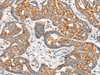 Immunohistochemistry of paraffin-embedded Human liver cancer tissue  using CCT8L2 Polyclonal Antibody at dilution of 1:45(×200)