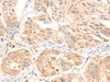 Immunohistochemistry of paraffin-embedded Human esophagus cancer tissue  using CCT8L2 Polyclonal Antibody at dilution of 1:45(×200)