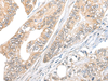 Immunohistochemistry of paraffin-embedded Human gastric cancer tissue  using TBCB Polyclonal Antibody at dilution of 1:25(×200)