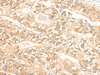 Immunohistochemistry of paraffin-embedded Human gastric cancer tissue  using DMC1 Polyclonal Antibody at dilution of 1:30(×200)