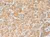 Immunohistochemistry of paraffin-embedded Human liver cancer tissue  using CRABP1 Polyclonal Antibody at dilution of 1:120(×200)