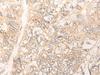 Immunohistochemistry of paraffin-embedded Human gastric cancer tissue  using CUTA Polyclonal Antibody at dilution of 1:40(×200)
