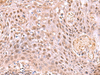 Immunohistochemistry of paraffin-embedded Human tonsil tissue  using DDI2 Polyclonal Antibody at dilution of 1:75(×200)