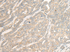 Immunohistochemistry of paraffin-embedded Human liver cancer tissue  using RSU1 Polyclonal Antibody at dilution of 1:30(×200)