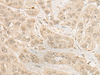 Immunohistochemistry of paraffin-embedded Human esophagus cancer tissue  using RSU1 Polyclonal Antibody at dilution of 1:30(×200)