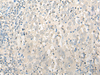 Immunohistochemistry of paraffin-embedded Human cervical cancer tissue  using UBXN1 Polyclonal Antibody at dilution of 1:35(×200)