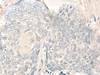 Immunohistochemistry of paraffin-embedded Human esophagus cancer tissue  using DIMT1 Polyclonal Antibody at dilution of 1:30(×200)