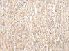 Immunohistochemistry of paraffin-embedded Human ovarian cancer tissue  using FYTTD1 Polyclonal Antibody at dilution of 1:30(×200)