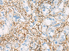 Immunohistochemistry of paraffin-embedded Human liver cancer tissue  using ACTC1 Polyclonal Antibody at dilution of 1:55(×200)