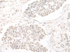 Immunohistochemistry of paraffin-embedded Human lung cancer tissue  using ILKAP Polyclonal Antibody at dilution of 1:50(×200)