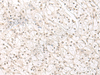 Immunohistochemistry of paraffin-embedded Human kidney cancer tissue  using HENMT1 Polyclonal Antibody at dilution of 1:30(×200)