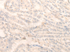 Immunohistochemistry of paraffin-embedded Human thyroid cancer tissue  using INPP1 Polyclonal Antibody at dilution of 1:35(×200)