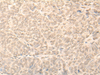 Immunohistochemistry of paraffin-embedded Human ovarian cancer tissue  using NARF Polyclonal Antibody at dilution of 1:45(×200)