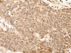 Immunohistochemistry of paraffin-embedded Human esophagus cancer tissue  using EIF4A3 Polyclonal Antibody at dilution of 1:45(×200)