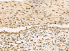 Immunohistochemistry of paraffin-embedded Human cervical cancer tissue  using GRWD1 Polyclonal Antibody at dilution of 1:90(×200)