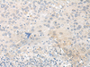 Immunohistochemistry of paraffin-embedded Human cervical cancer tissue  using TUBG2 Polyclonal Antibody at dilution of 1:50(×200)