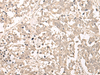 Immunohistochemistry of paraffin-embedded Human lung cancer tissue  using RRP1 Polyclonal Antibody at dilution of 1:45(×200)