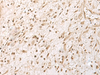 Immunohistochemistry of paraffin-embedded Human ovarian cancer tissue  using RRP1 Polyclonal Antibody at dilution of 1:45(×200)