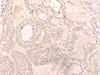 Immunohistochemistry of paraffin-embedded Human thyroid cancer tissue  using IGHA1 Polyclonal Antibody at dilution of 1:65(×200)