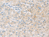 Immunohistochemistry of paraffin-embedded Human liver cancer tissue  using NCOA4 Polyclonal Antibody at dilution of 1:130(×200)