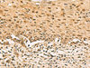 Immunohistochemistry of paraffin-embedded Human cervical cancer tissue  using SCMH1 Polyclonal Antibody at dilution of 1:120(×200)